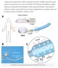 trustmyscience - Cet implant sous-cutané contrôle efficacement le diabète de type 1 en oxygénant les cellules pancréatiques (sur souris et rats)
