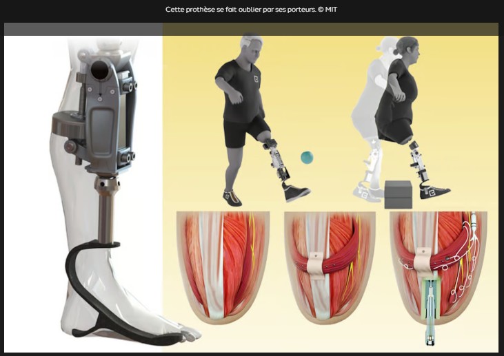 futura-sciences - Cette prothèse est directement implantée dans l’os et greffée aux muscles