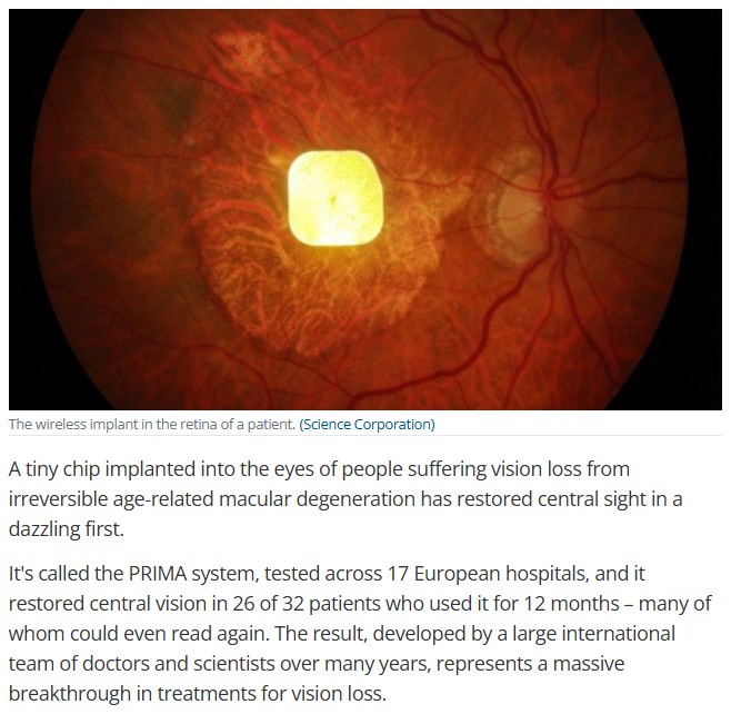 sciencealert - Revolutionary Prosthetic Eye Chip Restores Sight in Medical First