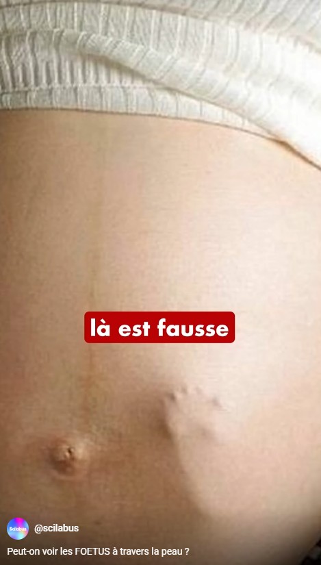 Scilabus - Peut-on voir les FOETUS à travers la peau (non)