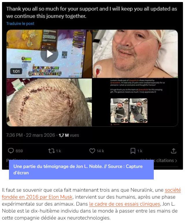 numerama - Comment un patient paralysé a pu jouer à World of Warcraft par la pensée - Neuralink