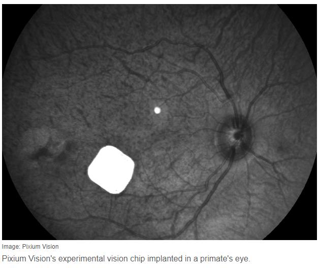 Pixium visionfrench-regulators-approve-human-trial-of-a-bionic-eye.jpg