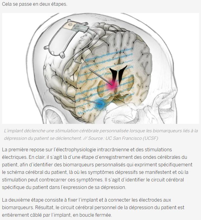 numerama.com un-implant-cerebral-contre-la-depression-resistante-a-fait-ses-preuves-pour-la-premiere-fois.jpg