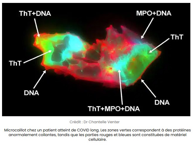 sciencepost - COVID long, ça pourrait résider dans quelque chose d’infiniment petit : des microcaillots