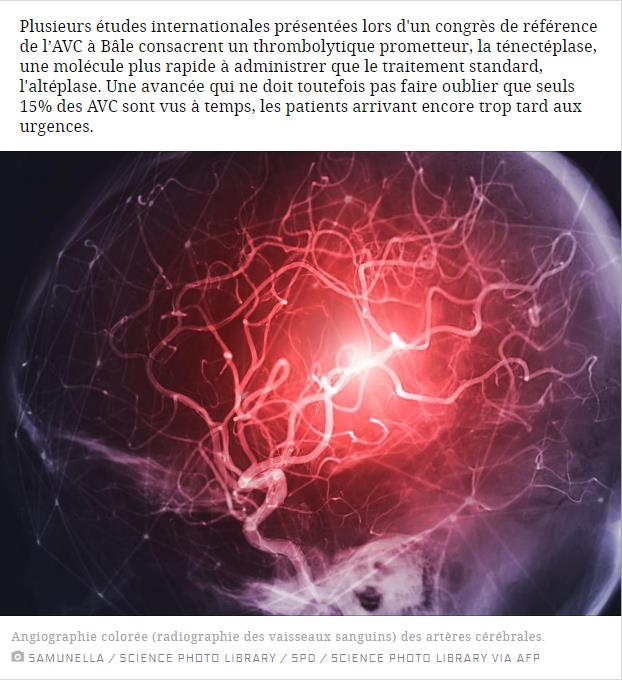 Angiographie colorée (radiographie des vaisseaux sanguins) des artères cérébrales. SAMUNELLA / SCIENCE PHOTO LIBRARY / SPD / SCIENCE PHOTO LIBRARY VIA AFP