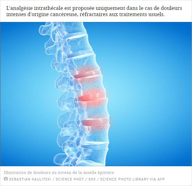 L'analgésie intrathécale est proposée uniquement dans le cas de douleurs intenses d'origine cancéreuse, réfractaires aux traitements usuels.