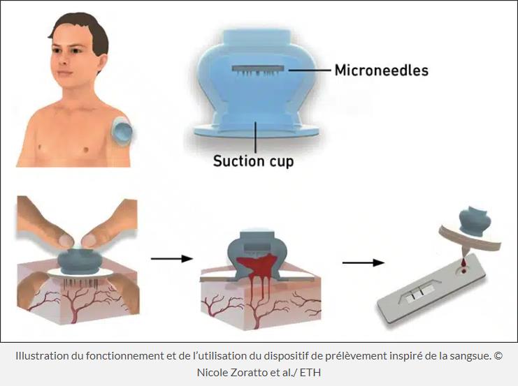 Un nouveau dispositif inspiré de la sangsue pour prélever facilement du sang (de façon peu invasive) et qui ne nécessite pas de formation médicale