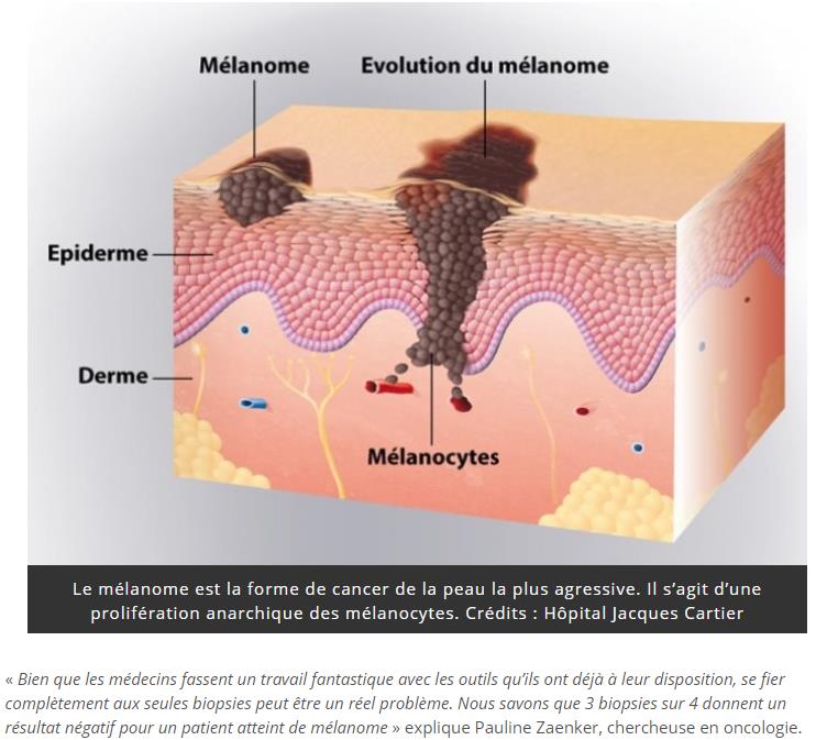 trustmyscience.com nouveau-test-sanguin-detecte-melanomes.jpg
