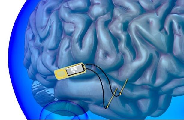 trustmyscience.com nouveau-type-implant-cerebral-augmente-memoire-de-15-pourcent.jpg
